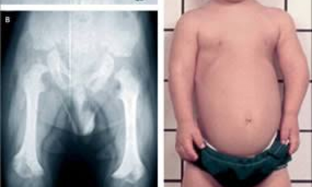 DWARFISM: growth deficiency.