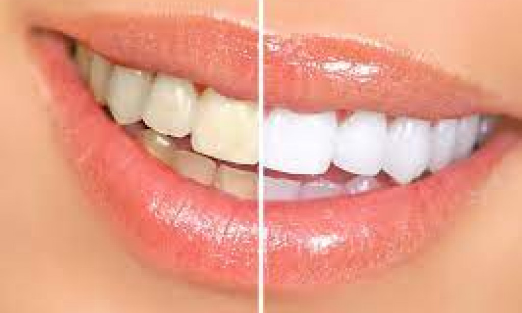 How a lot does it cost to get your enamel professionally whitened?