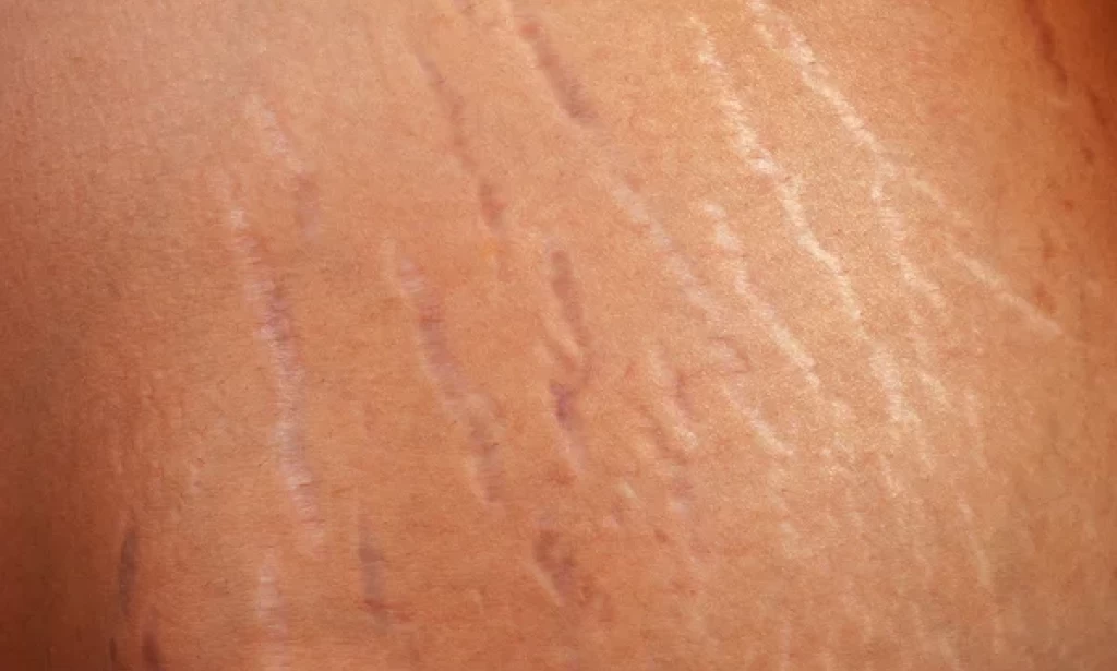 How to get rid of stretch marks