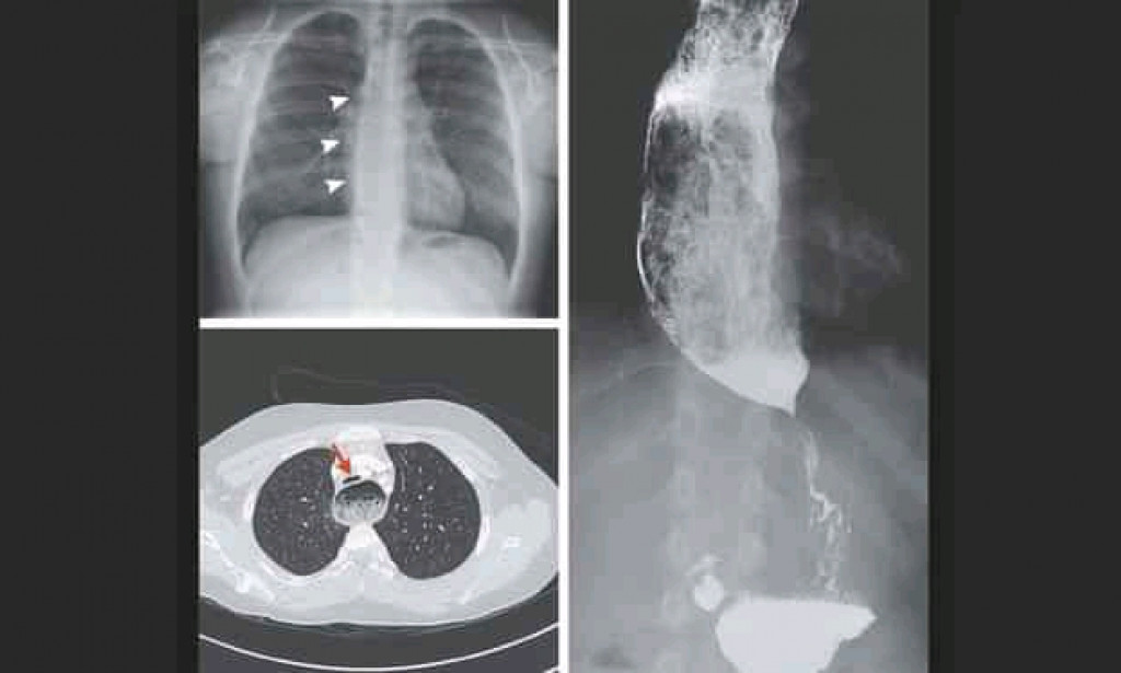 Achalasia Definitions and Meaning