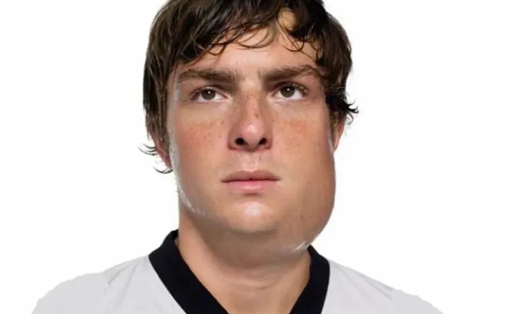 Mumps signs and symptoms