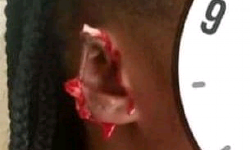UNIVERSITY  STUDENT BITES OFF COLLEAGUE’ EAR IN FIGHT FOR BOYFRIEND
