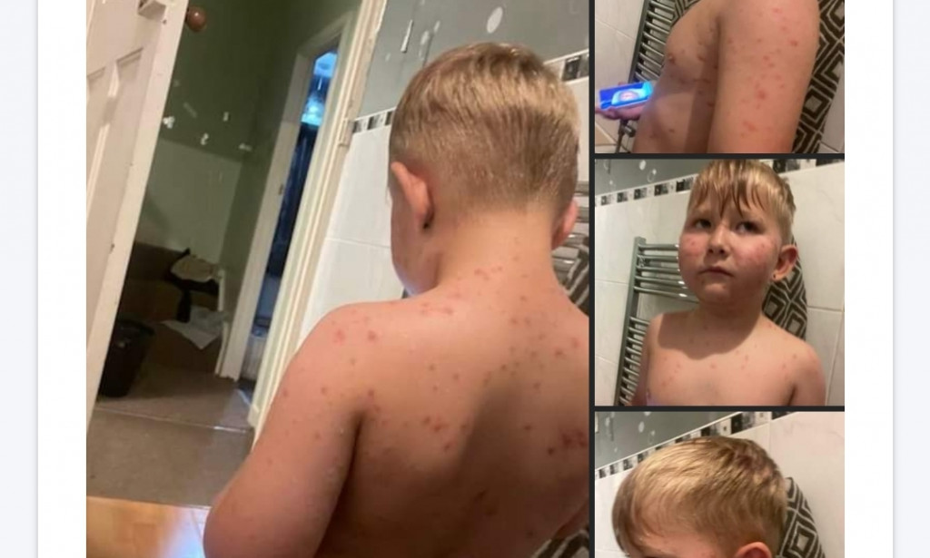 Monkeypox continues to spread in the US and UK as Facebook users post more confirmed cases