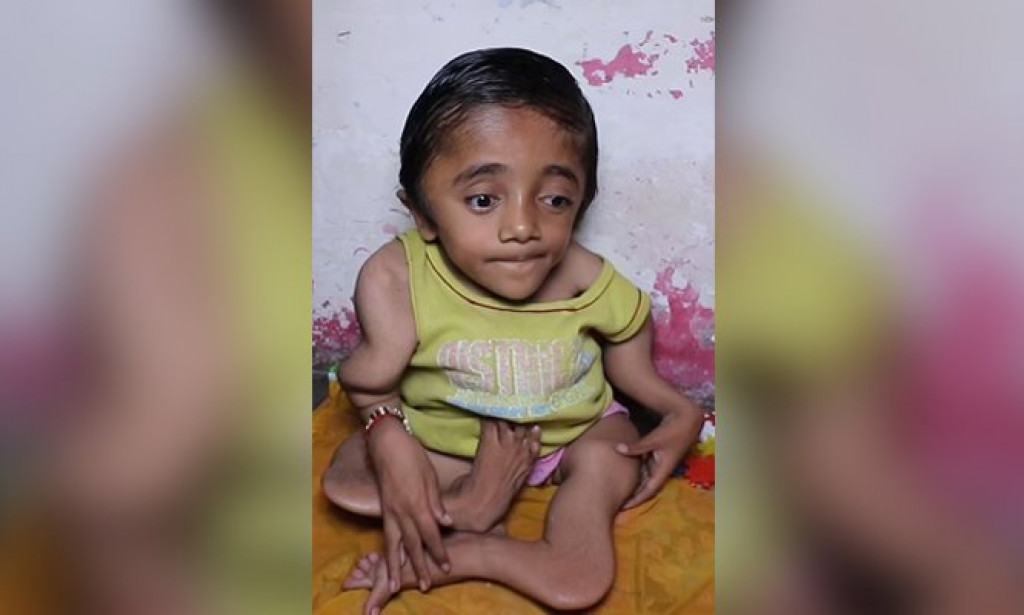 Made of glass': 12-year-old boy breaks over 100 bones due to osteoporosis