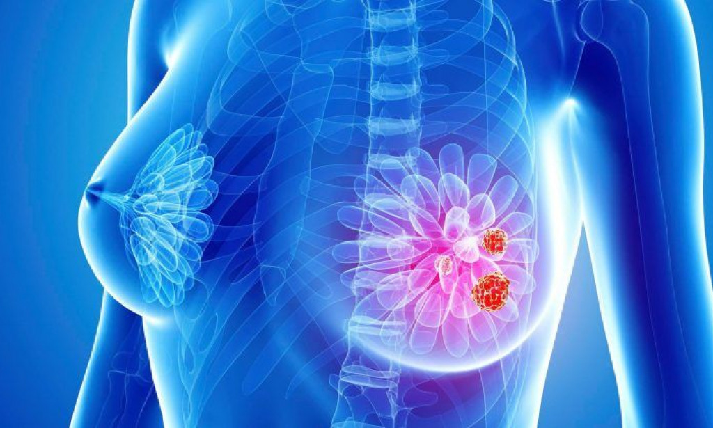 Breast Cancer: 5 Everyday Habits That Can You At Greater Risk