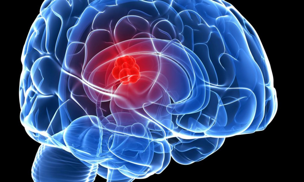 Having Constant Headaches? Beware Of These 7 Silent Symptoms Of Brain Cancer