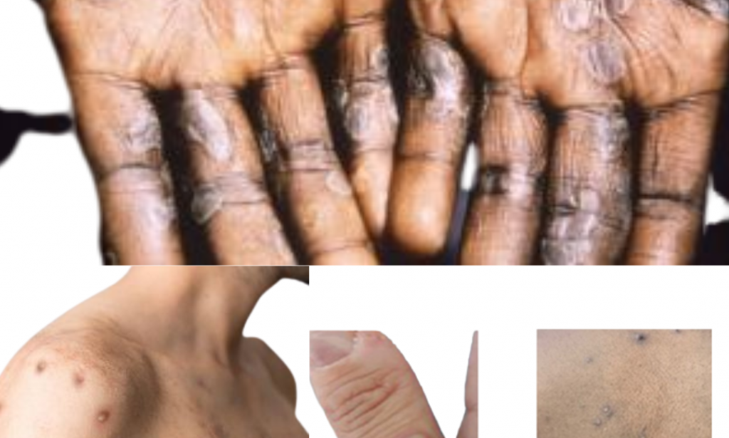 Monkey Pox emergency.