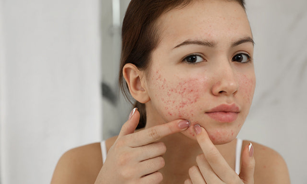 3 Foods You Shouldn't Eat To Avoid Pimples