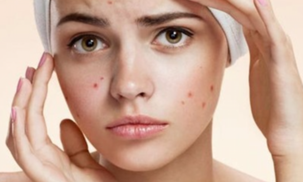 3 Natural Ways You Can Treat Facial Pimples