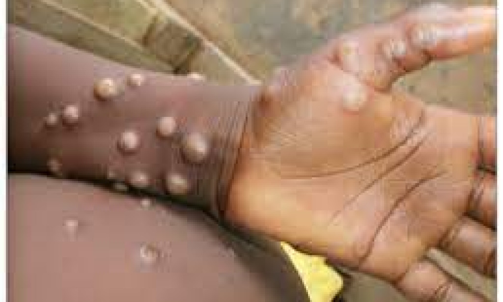 MONKEY POX, Why you need to learn more about it
