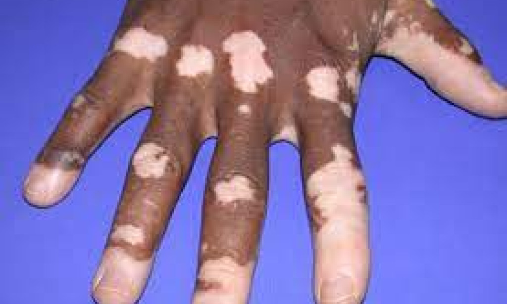 Leprosy (Hansen's Disease): Causes, Symptoms & Treatment