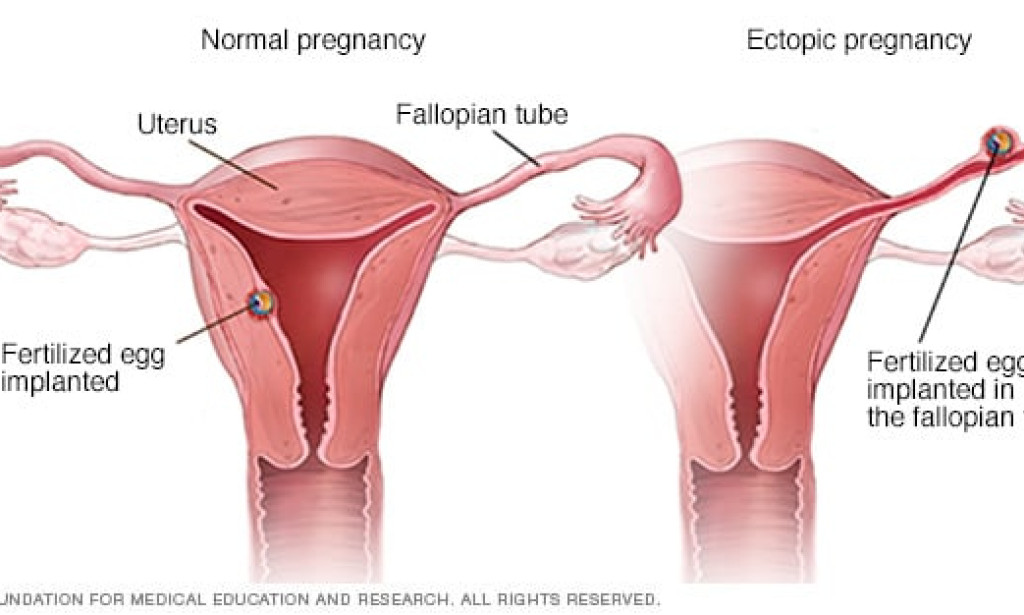 ECTOPIC PREGNANCY