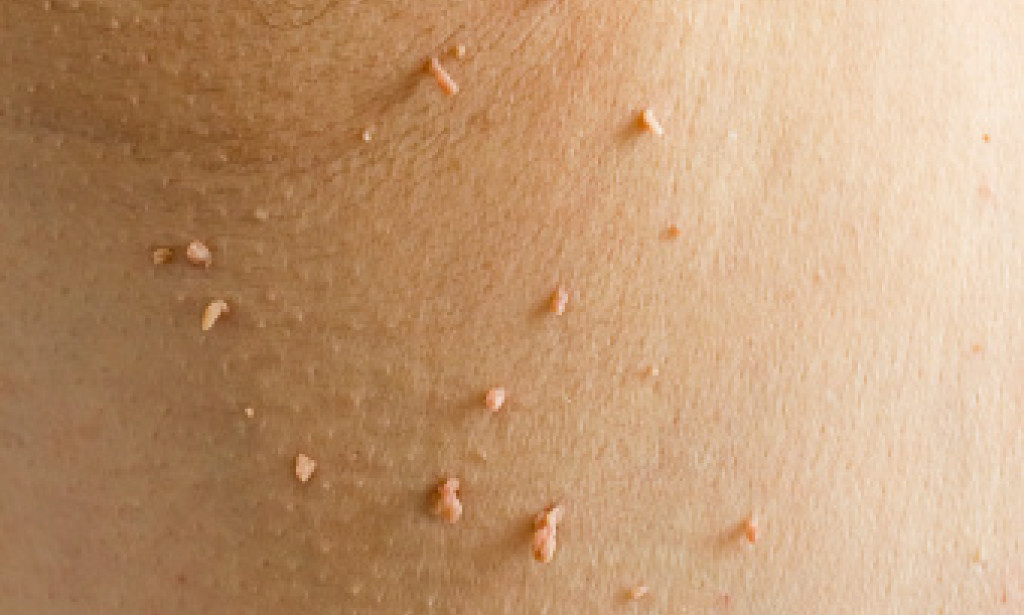 Causes of skin tags