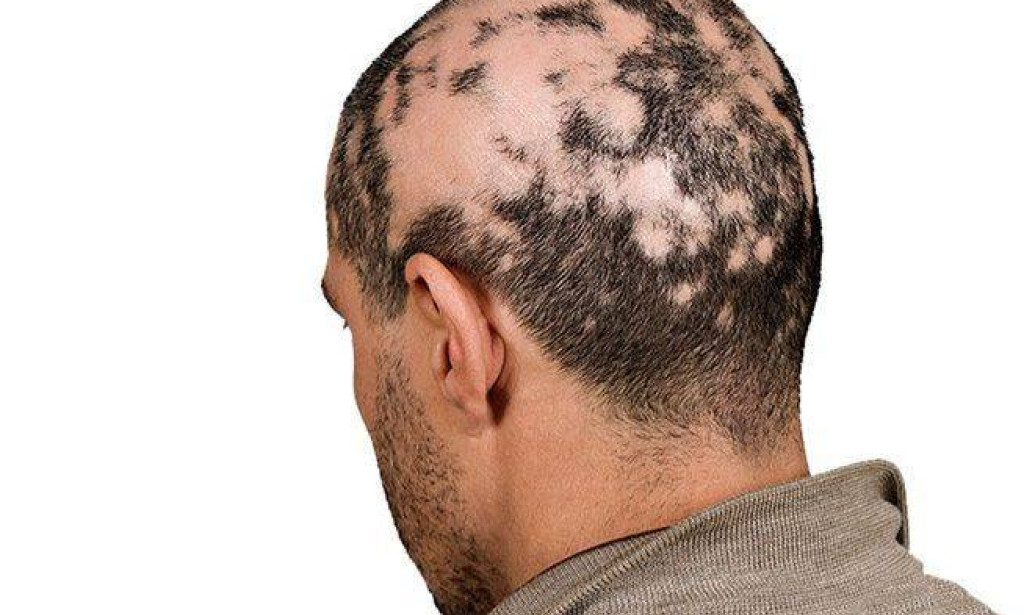 The Causes of Alopecia