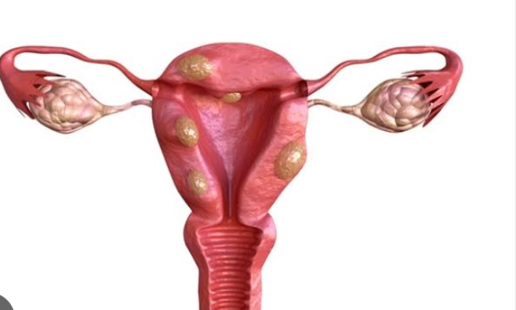 Common Signs Of A Woman With Fibroids You Shouldn't Ignore Go For Check If You Notice This.