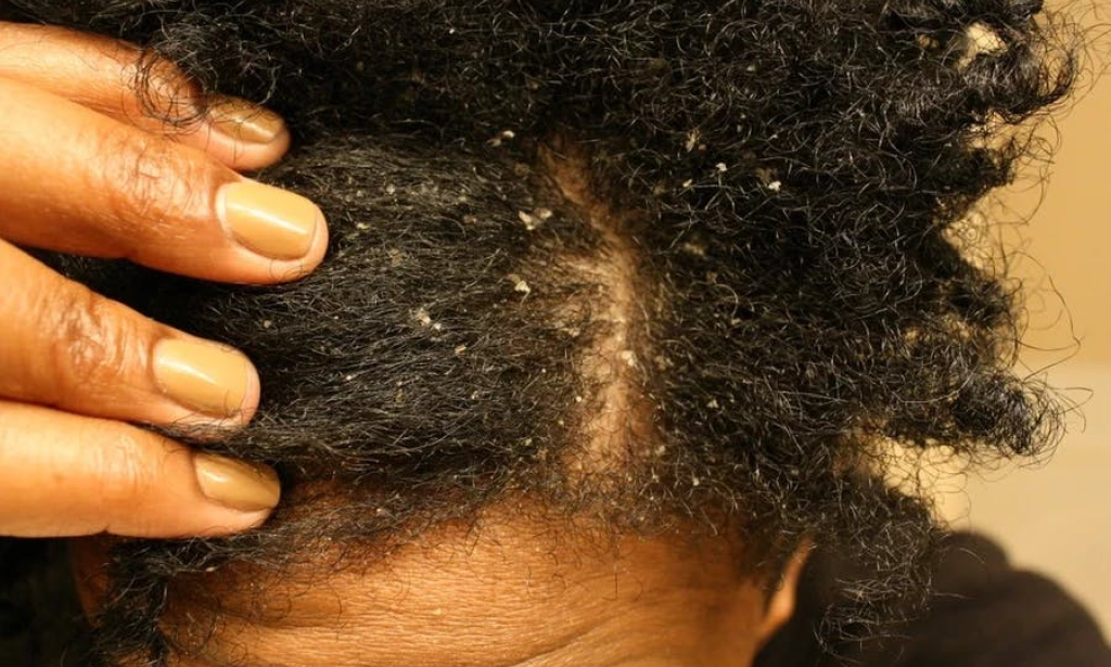 How to get rid of dandruff in one wash: Do this and thank me later.