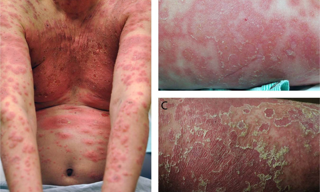 Unknown genetic connection found in cases of widespread pustular psoriasis