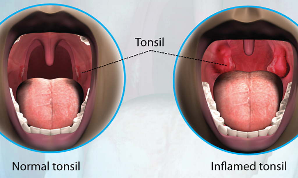 Tonsillitis: Overview, Causes, Symptoms, Diagnosis, Treatment, and Prevention