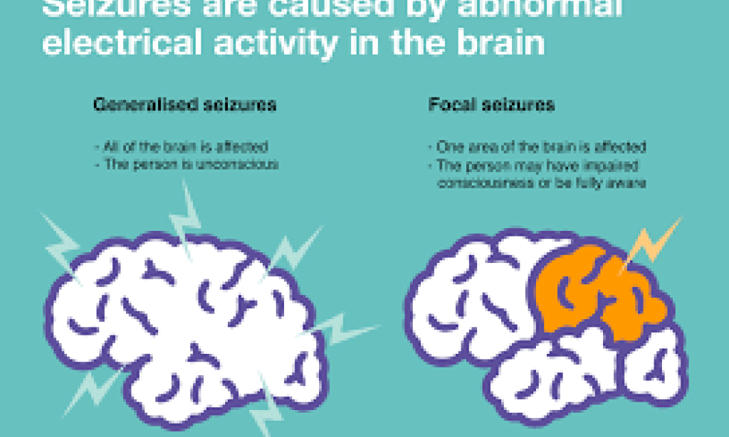 Gabapentin for Epilepsy: Benefits, Side Effects, and Dosage Guidelines