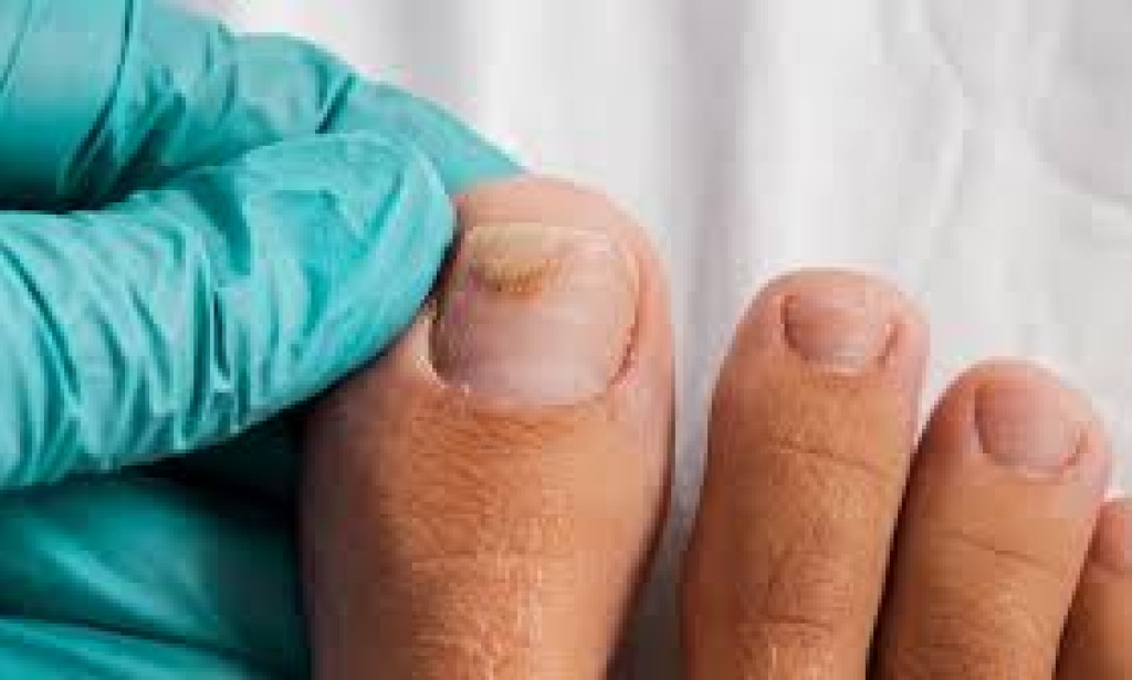 How Nail Salons Are Leaving Women with Painful Infections