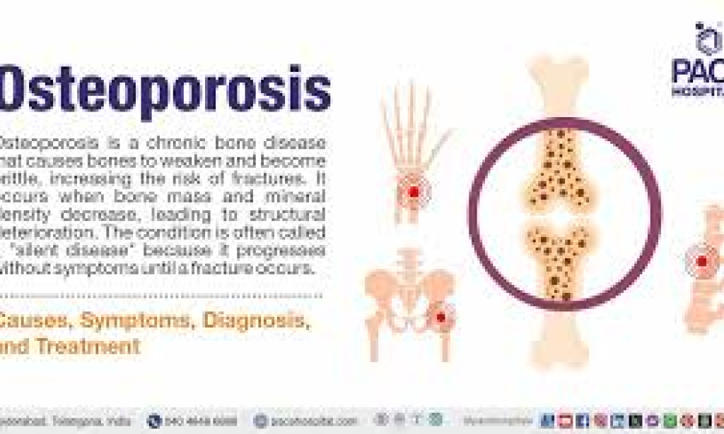 Osteoporosis: Symptoms, causes and treatment